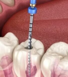 Root-Canal-Treatment-1440x720-1-1024x512-364x234