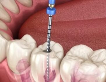 Root-Canal-Treatment-1440x720-1-1024x512-364x234