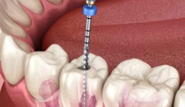 Root Canal Treatment