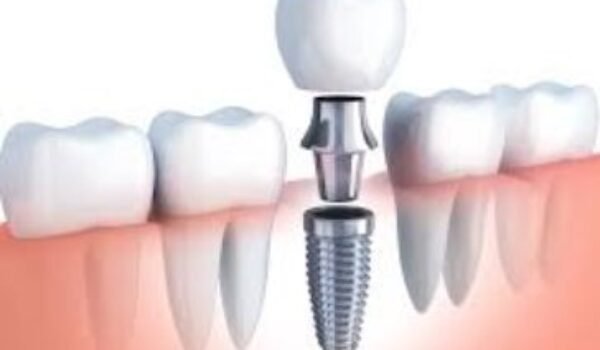 Dental Implant